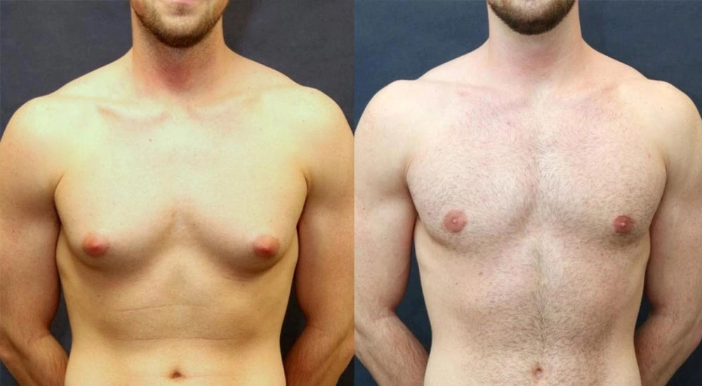 Gynecomastia