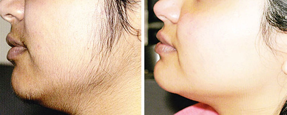 abdominoplasty