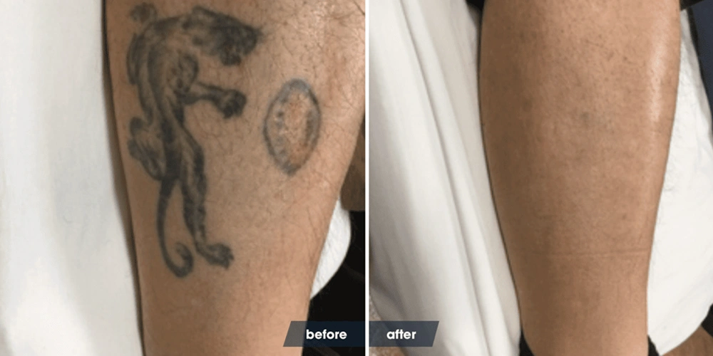 abdominoplasty